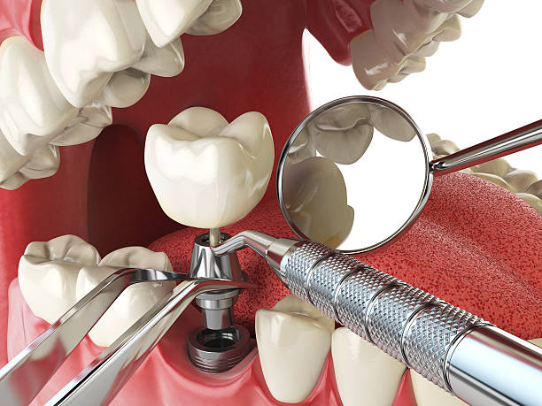 Best Emergency Root Canal Treatment in Stinnett, TX